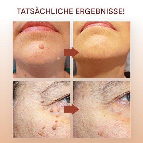 WartOff Skin Spot Remover Painless Natural Formula 1 Get 1 Free