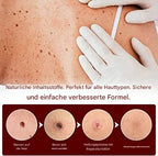 WartOff Skin Spot Remover Painless Natural Formula 1 Get 1 Free