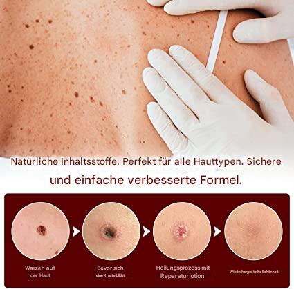 WartOff Skin Spot Remover Painless Natural Formula 1 Get 1 Free