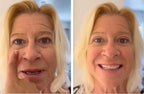 EyePerfection | Double Eyelid Tape for Drooping Eyelids | Unisex